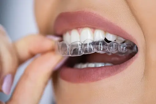 How Much Are Braces with Insurance