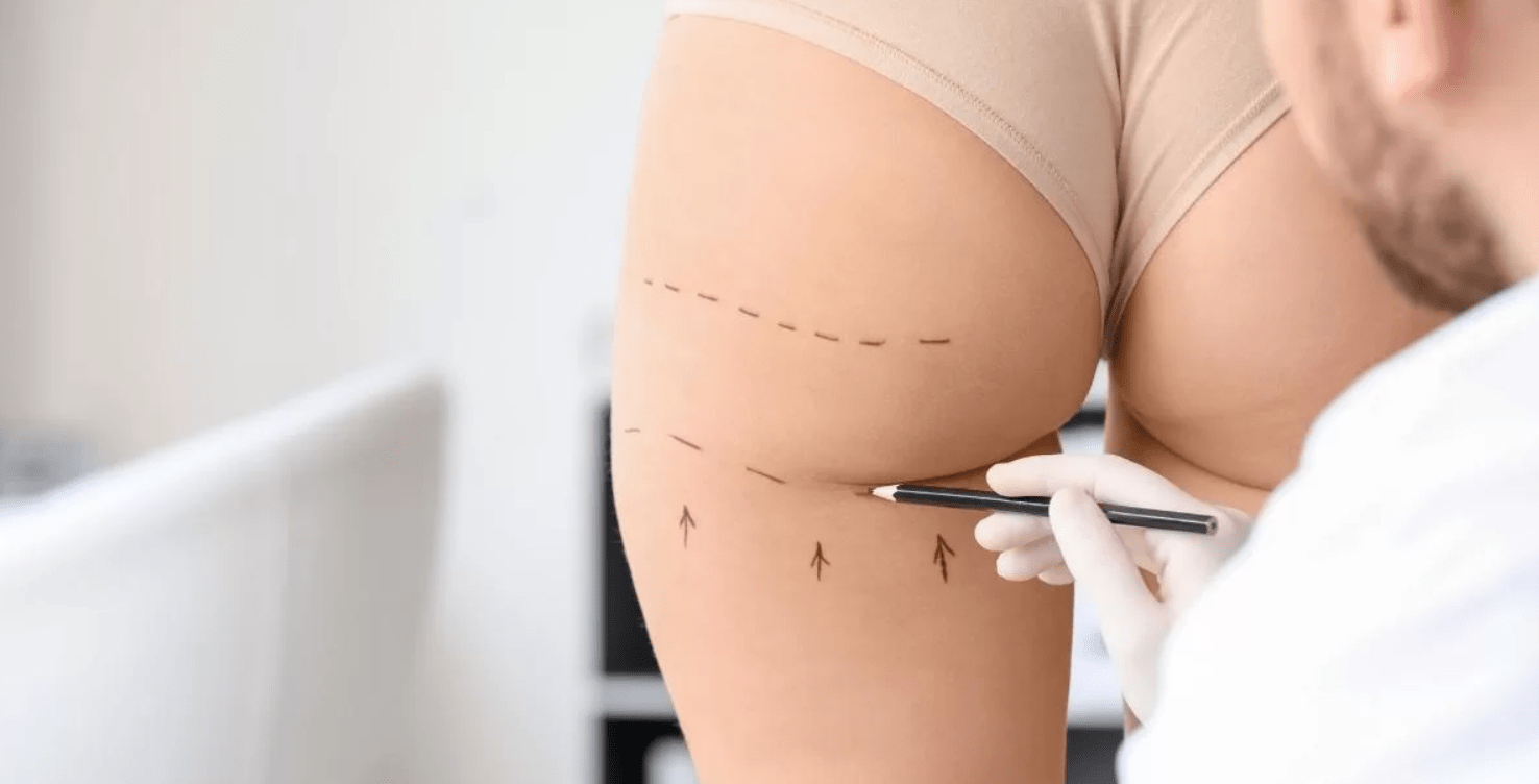 5 Common Myths About Buttock Fat Transfer in Dubai Debunked