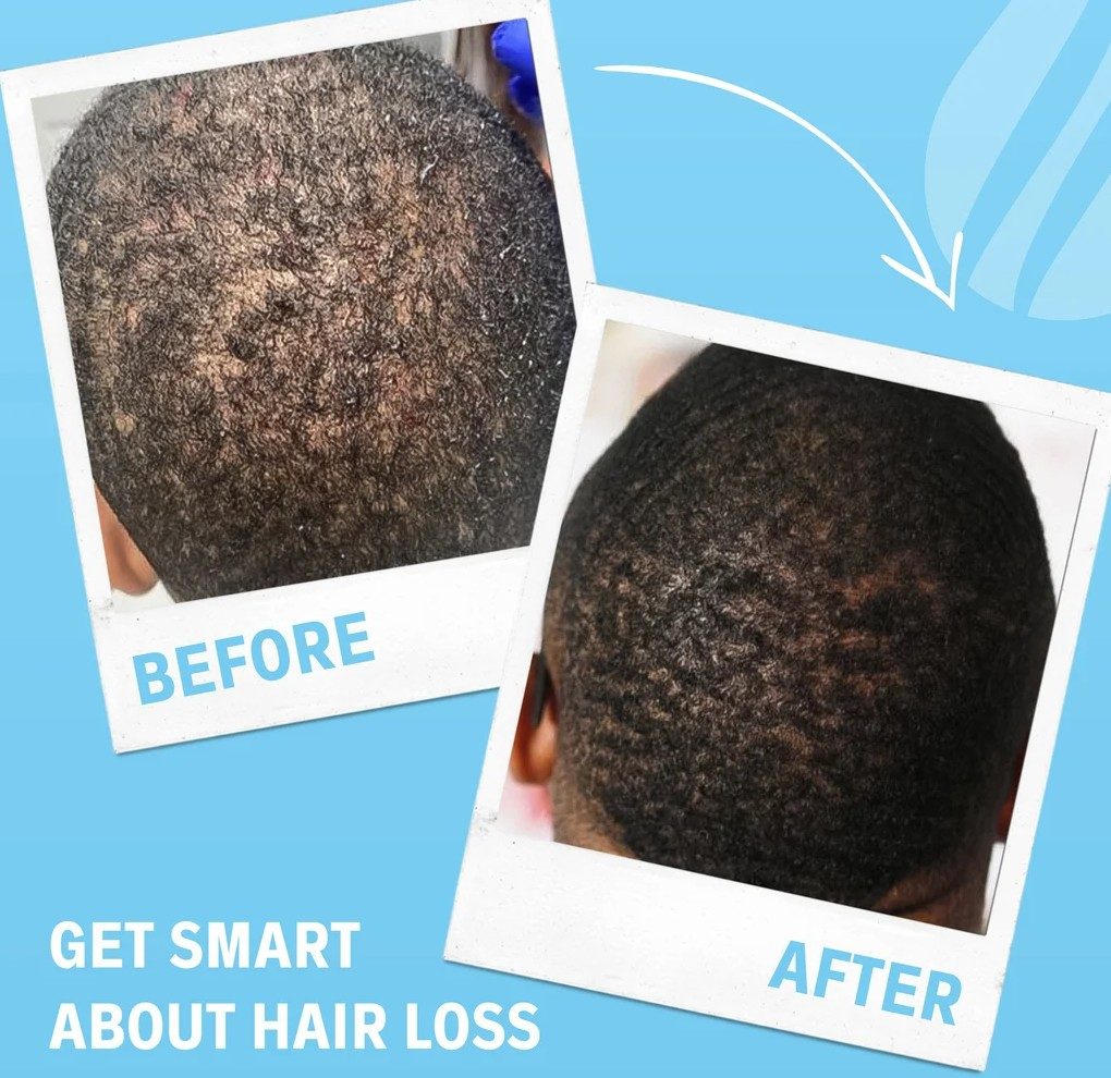 SmartGraft Hair Restoration Fort Lauderdale: Regrow Naturally