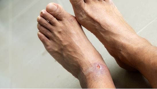 How Diabetes Affects Your Feet? – An Ultimate Guide