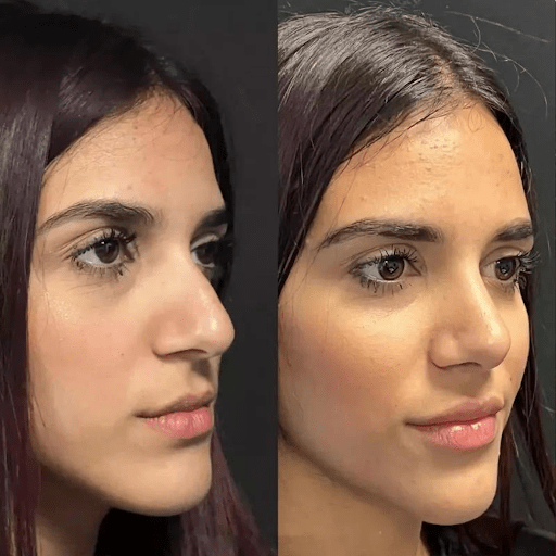 Why the Best Doctors in Dubai Are the Key to Rhinoplasty Perfection