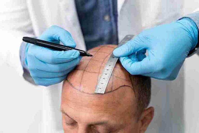 Understanding-Hair-Transplant-Surgery-Costs-in-Gurgaon-Noida-and-Lucknow_11zon