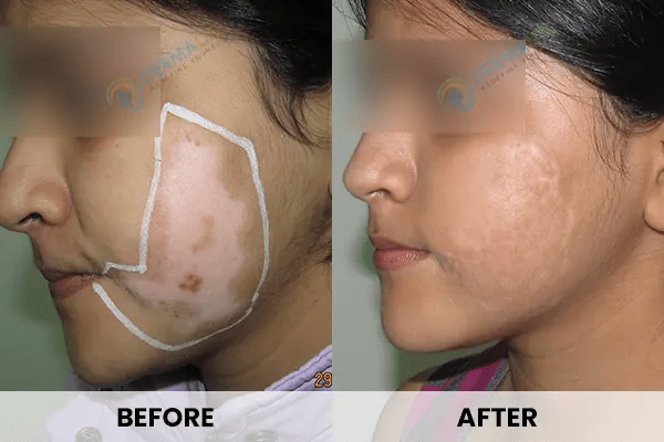 Vitiligo-Treatment-Before-After