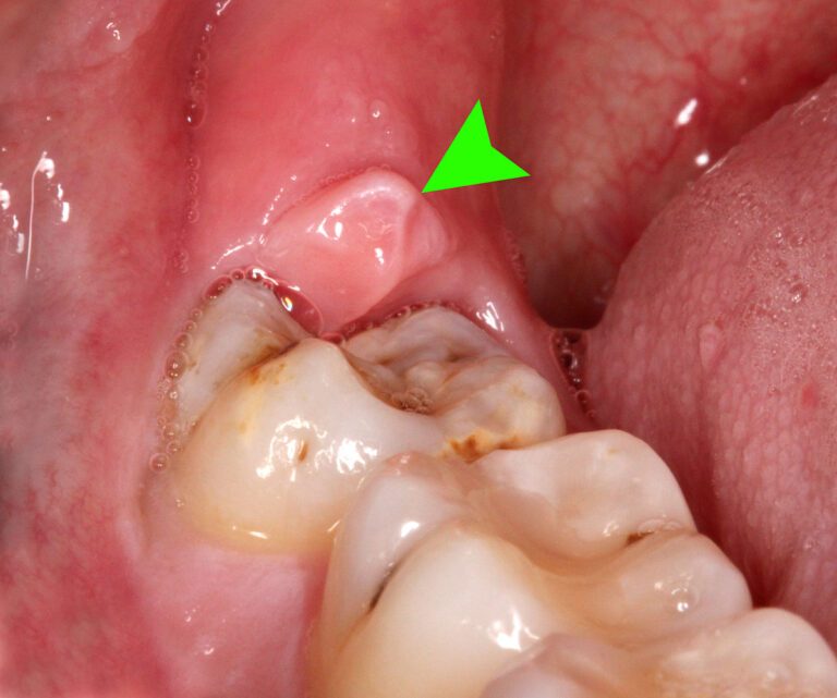 Wisdom-Tooth-is-Infected_14729