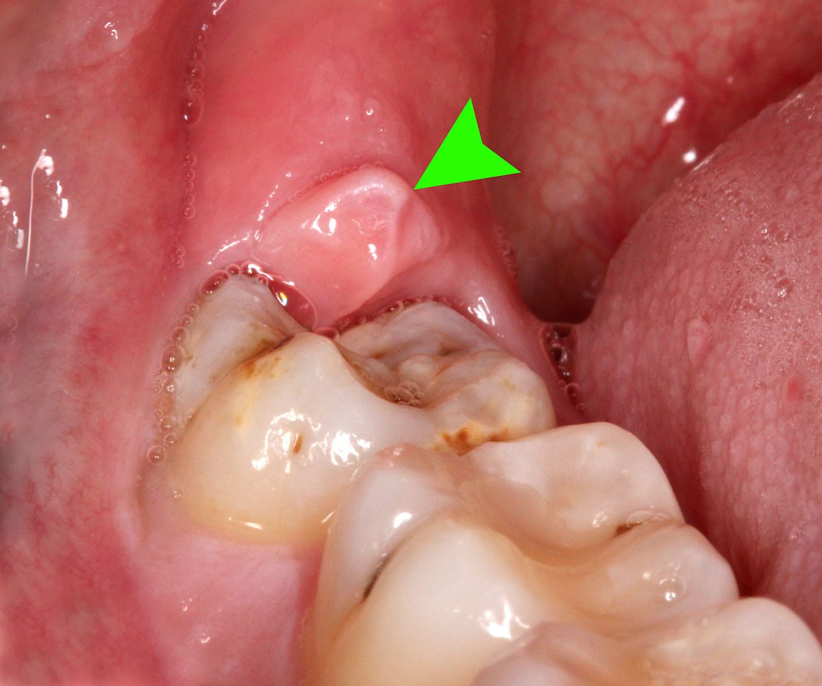 Black Spots on Teeth: What Causes Them If They’re Not Cavities?