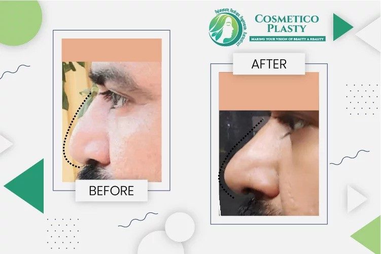 Finding the Best Rhinoplasty Surgeon in Lahore: A Comprehensive Guide