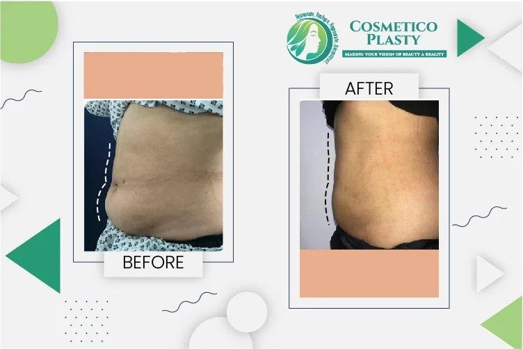 Liposuction in Lahore: Transform Your Body with Expert Care