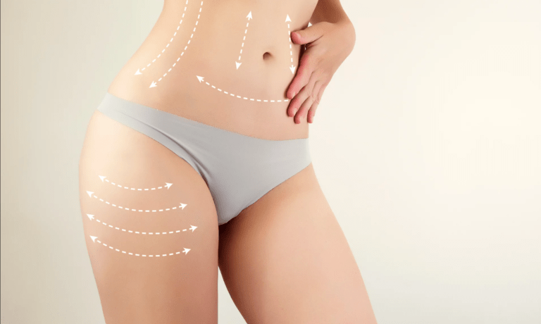 Best-Liposuction-Surgery-Cost-in-Dubai