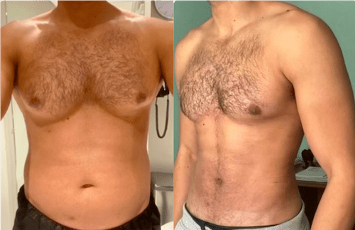 Gynecomastia Surgery in Dubai: Why It’s a Life-Changing Solution