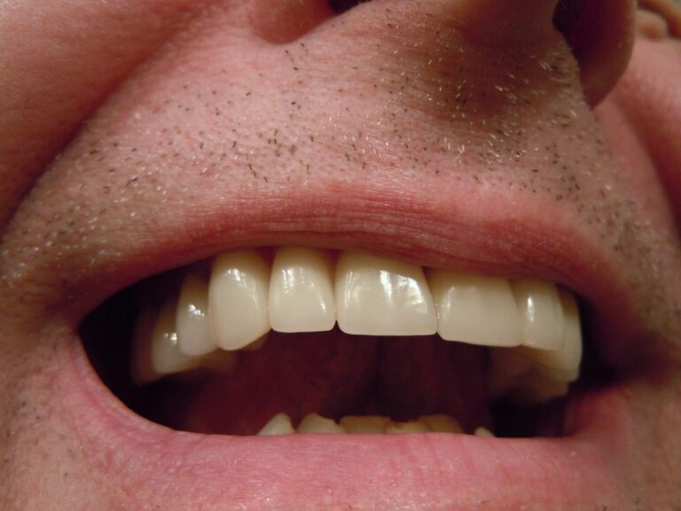 teeth-414489_960_720