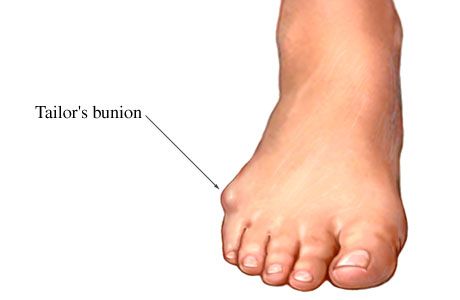 Why Are Bunionette Services Recommended by Foot Specialists?