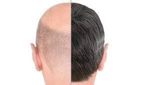 Hair Transplant in Dubai – Cost, Benefits & Procedure