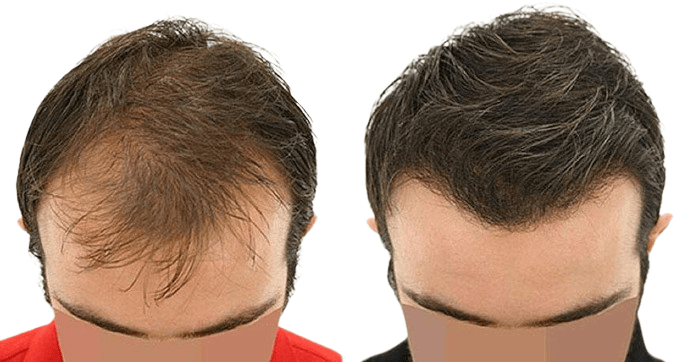 زراعة الشعر في دبي: نصائح لما بعد العملية للحصول على أفضل النتائج 💇‍♂️✨