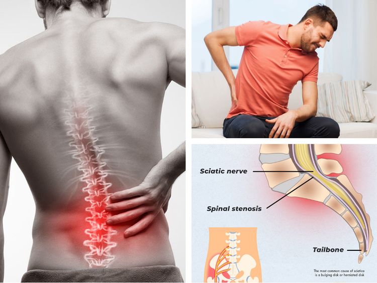 Is Your Back Pain Actually Sciatica? Dr. Gautam Arora’s Expert Insights