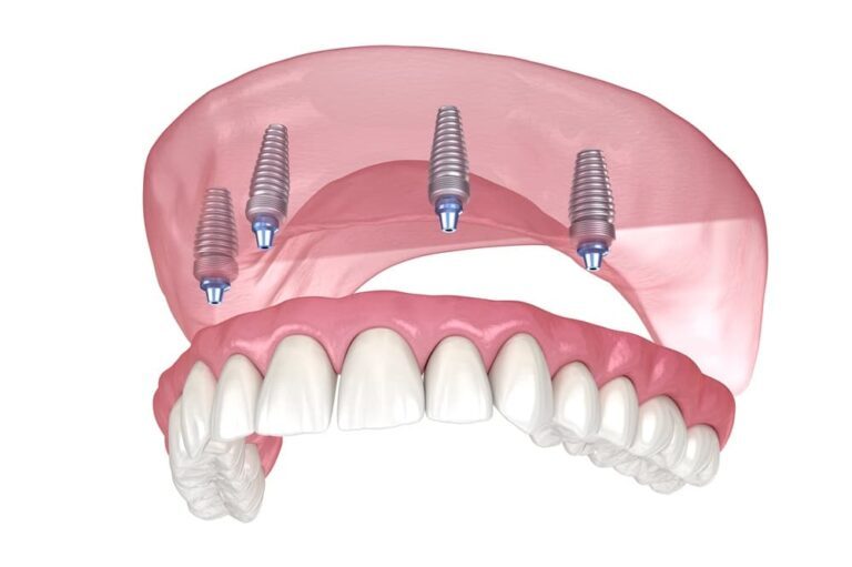 Zygomatic-Implants-1