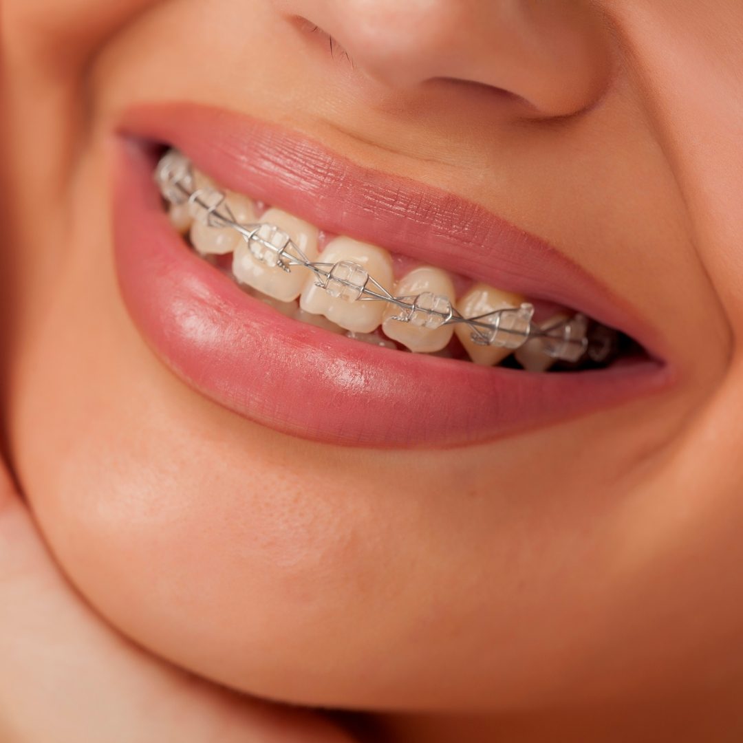 Can Adults Get Braces? The Truth About Orthodontics at Any Age