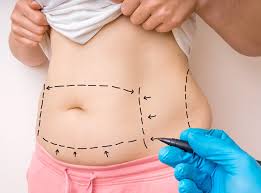 Sculpt Your Dream Body with a Premium Tummy Tuck in Dubai