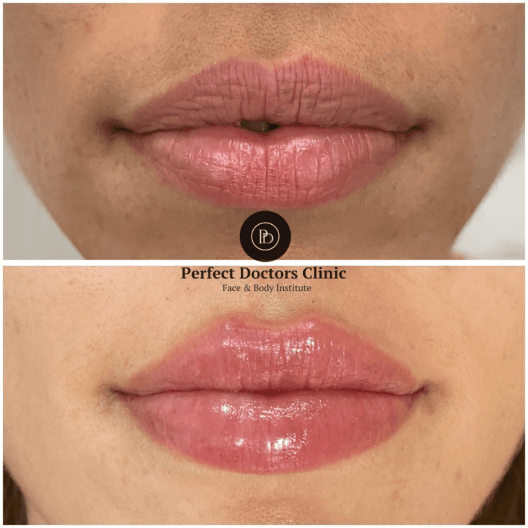 Copy-of-lip-filler-6