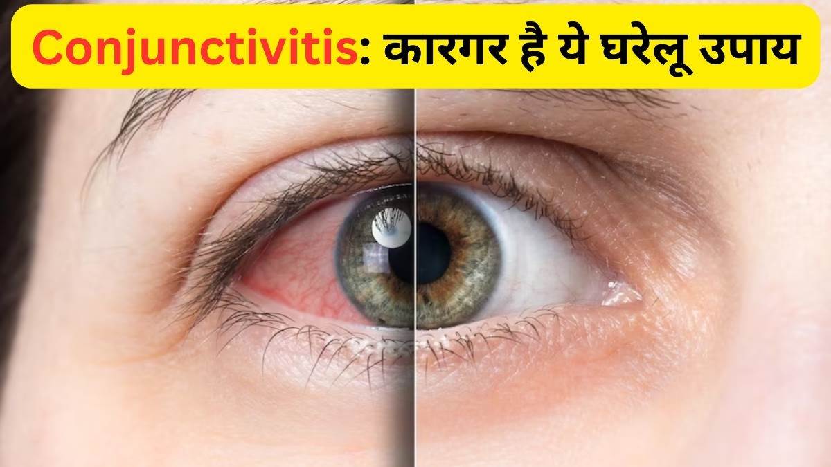 आई फ्लू के लक्षण और शुरुआती संकेत